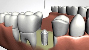 art3-Batch#4921-kw3- implantes dentales madrid