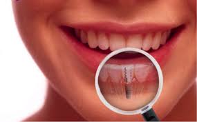 Cuanto cuesta un implante dental Cuanto cuesta un implante dental